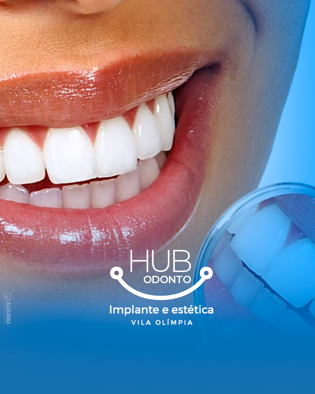 HubOdontoVilaOlimpia-lente_de_contato_dental