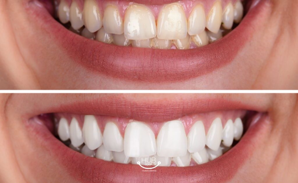 clareamento dental na vila olimpia