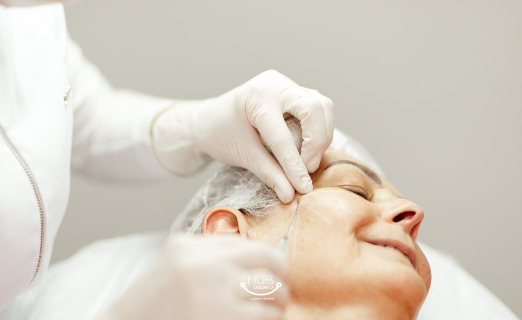 Aplicação de bioestimulador de colágeno na Vila Olímpia