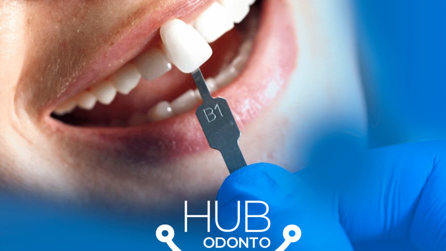 HubOdontoVilaOlimpia-Facetas_e_lentes_de_contato