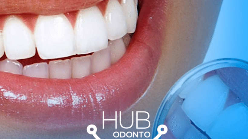 HubOdontoVilaOlimpia-lente_de_contato_dental