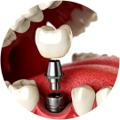 implantes dentarios - icone - 01 HubOdontoVilaOlimpia