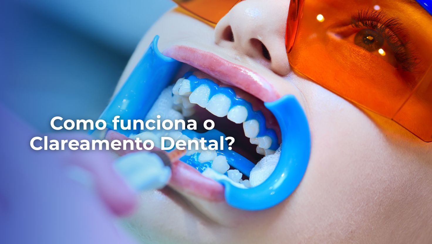 Paciente sorrindo após clareamento dental na Hub Odonto em Vila Olímpia
