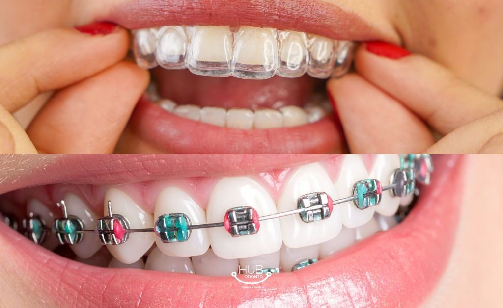 Alinhadores dental
