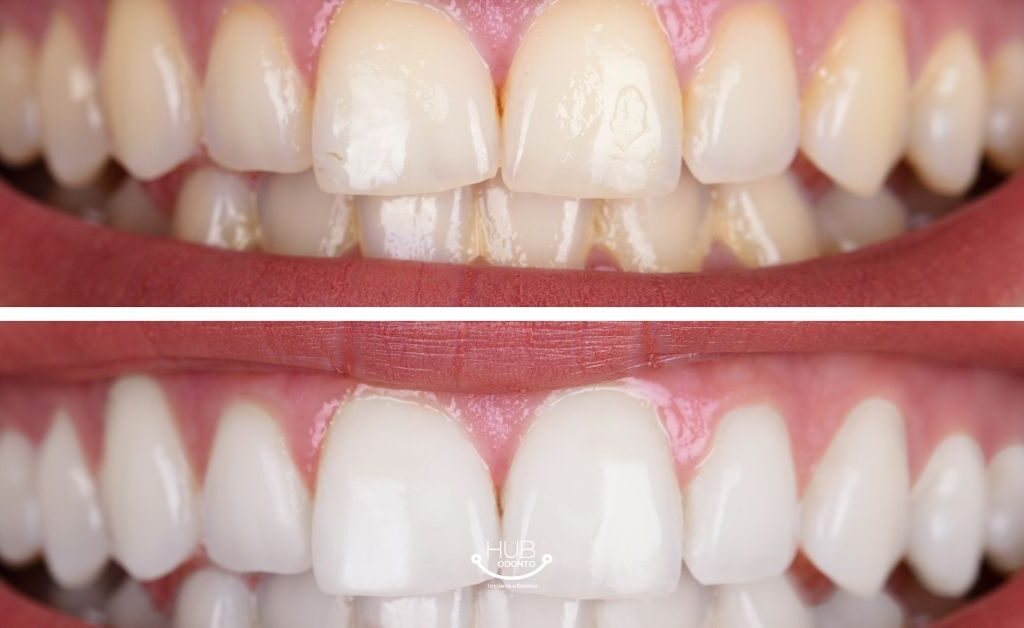 clareamento-dental-moema-hub-odonto.jpg