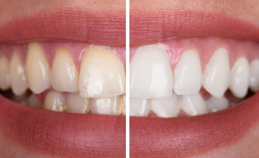 Dentista próximo ao Itaim Bibi na Hub Odonto, clínica odontológica na Vila Olímpia especializada em check-up, limpeza dental e odontologia preventiva.