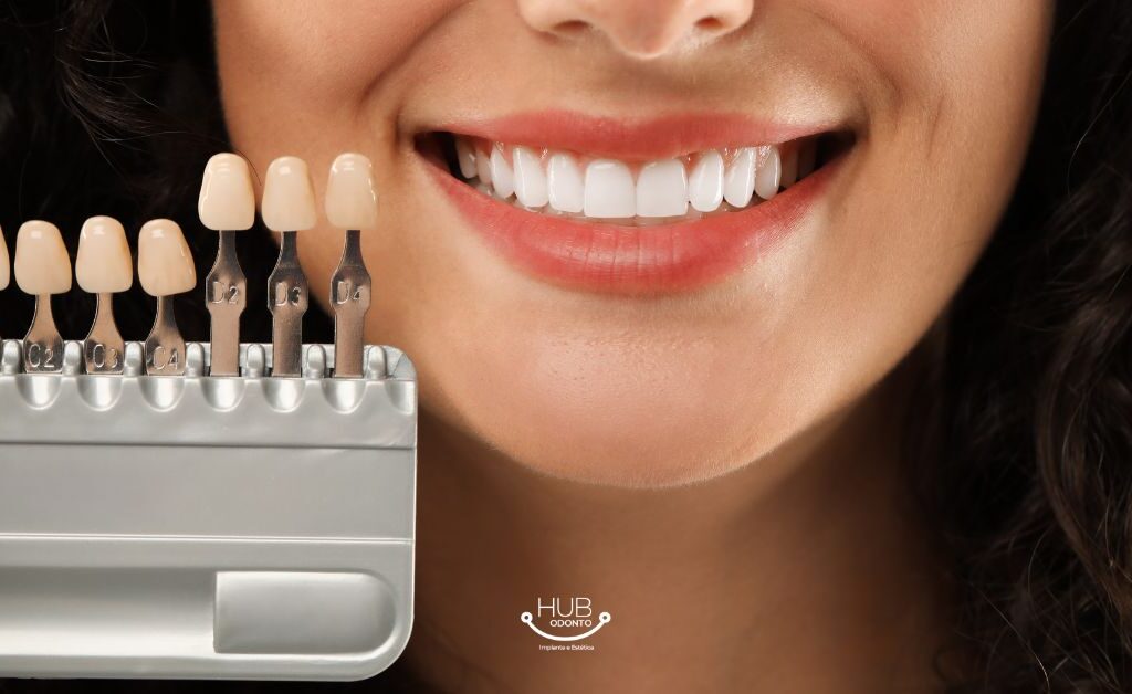 facetas-dentarias-moema-hub-odonto.jpg